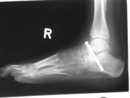 Röntgenbild eines Fußes, detaillierter