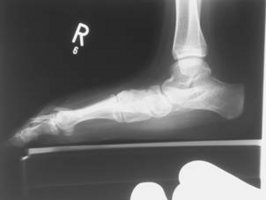 Röntgenbilde eines Fußes