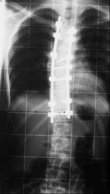 Röntgenbild der Wirbelsäule Nr. 2