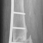83-jährige Patientin, nicht geheilte Oberschenkelfraktur, Versorgung durch Spezial-Knieprothese