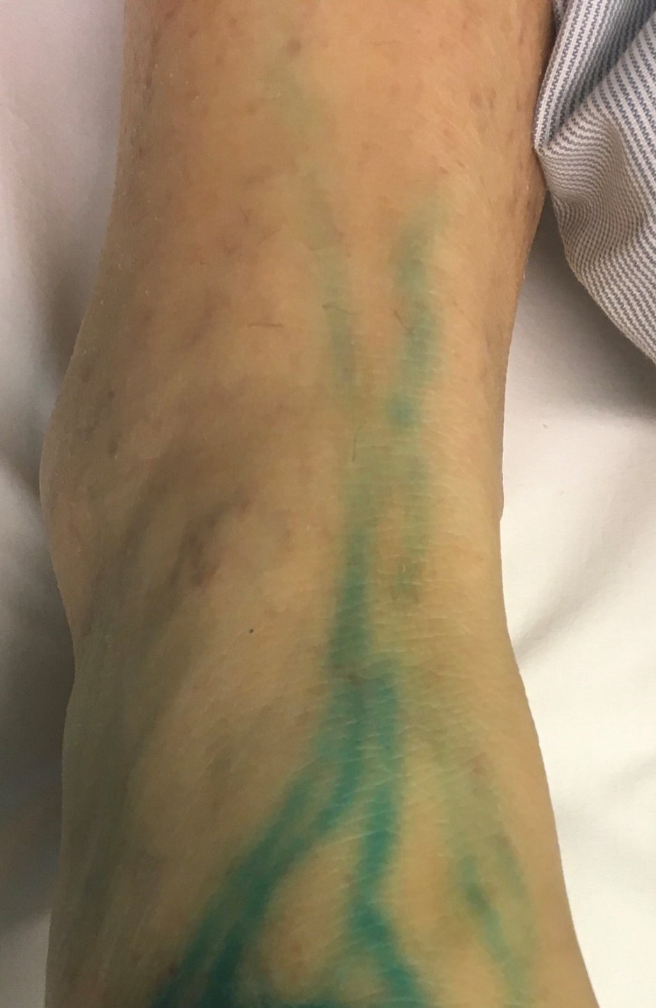 Lymphographie – Ein Farbstoff macht die feinen Lymphgefäße am Fußrücken sichtbar