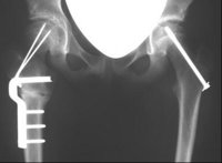 Röntgenbild ECF nach Eingriff