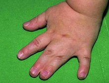 Kinderhand mit zwei zusammengewachsenen Fingern