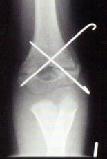 Röntgenbild Gelenk Nr. 3