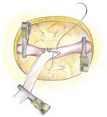 Die Abbildung zeigt eine Gefäßanastomose (Bypass) zwischen einer extrakraniellen Arterie und einem Hirngefäß. Während der Gefäßnaht müssen die Gefäße mittels der dargestellten Metallclips aus der Blutzirkulation ausgeschaltet werden.