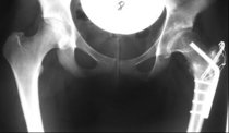 Röntgenbild der Hüfte mit Prothese