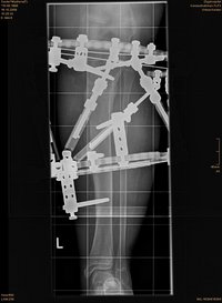 Röntgenbild der Längen- und Achskorrektur