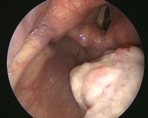 Bösartiger Tumor der Oropharynx-Hinterwand in der endoskopischen Darstellung