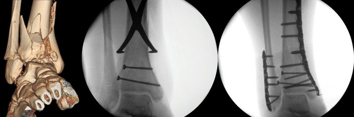 Fußchirurgie und Sprunggelenkschirurgie