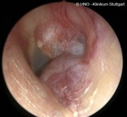 Aufnahme eines Glomustumors des linken Ohres