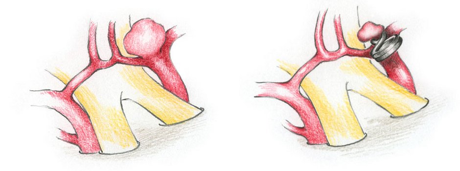 Die Abbildungen zeigen ein Aneurysma der Teilungsstelle der Arteria carotis interna, in unmittelbarer Nähe zum Sehnerv (hier gelb dargestellt). Nach Aufbringen eines Titanclips erschlafft das Aneurysma, da es nicht mehr durchblutet wird.