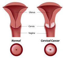 Schematische Darstellung Gebärmutterhalskrebs