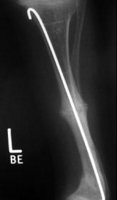 Röntgenbild Glasknochenkrankheit Nr. 4