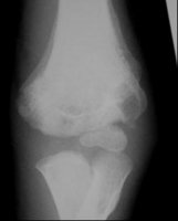 Röntgenbild Osteomyelitis