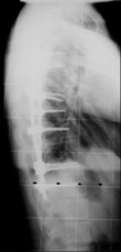 Röntgenbild der Wirbelsäule Nr. 3