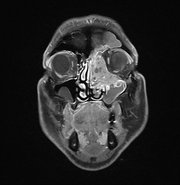 CT-Aufnahme eines Kopfes mit einem Tumor der Nasenhaupthöhle