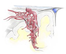 Die Abbildung zeigt eine von der Hirnoberfläche bis zur Hirnkammer ziehende arterio-venöse (AV)-Malformation (Angiom).Es zeigen sich viele kleine Arterien, welche über Kurzschlüsse in eine arterialisierte Vene münden. 