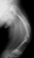 Röntgenbild Glasknochenkrankheit Nr. 1