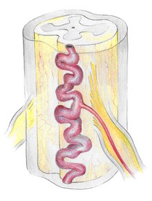 Die Abbildung zeigt eine spinale arterio-venöse (AV)-Fistel. Hierbei besteht eine Kurzschlussverbindung zwischen einer Arterie, welche wie hier entlang einer Nervenwurzel verläuft, und einer auf dem Rückenmark befindlichen Vene.