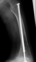 Röntgenbild Glasknochenkrankheit Nr. 2