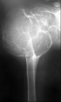 Röntgenbild Knochentumor