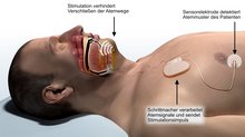 Schema des Hypoglossus-/Zungenschrittmachers – Das komplette System befindet sich unter der Haut. Foto: inspiresleep.com