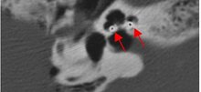 Digitale Volumentomografie (DVT): Die Pfeile zeigen auf die Elektrode in der Hörschnecke