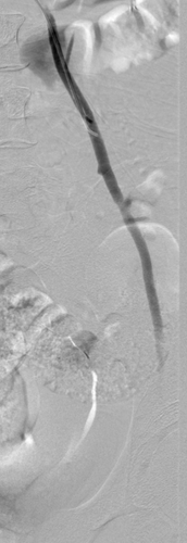 Angiographie nach Embolisation: Geringe Mengen eines Gefäßklebers verhindern nun den Rückstau in die Venen am Hoden.