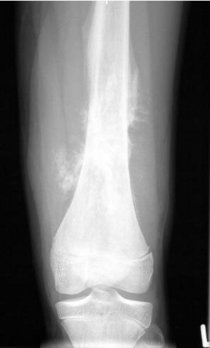 Röntgenbild eines Femurs mit einem Osteosarkom