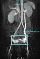 Anatomie – erweiterte linke Ovarialvene sowie   erweitertes Venengeflecht im Becken (MRT)