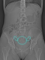 Anatomie – Lokalisation von Gebärmutter      und Eierstöcken (Röntgenbild des Beckens)
