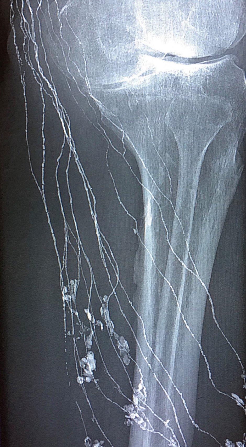 Lymphographie – Lipiodol wird über das Lymphsystem abtransportiert (Röntgenbild des Unterschenkels)