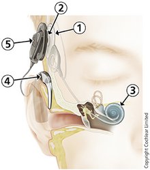Bild 1: 1 - Empfängerspule; 2 - Magnet; 3 - Innenohrelektrode; 4 - Sprachprozessor; 5 - Sendespule; Foto: Cochlear Limited
