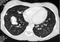 CT-Bild der Lunge mit pulmonaler Metastasierung