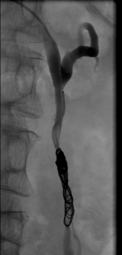 Angiographie nach Embolisation: Kleine Metallspiralen (Coils) verhindern nun den Rückstau in die Beckenvenen