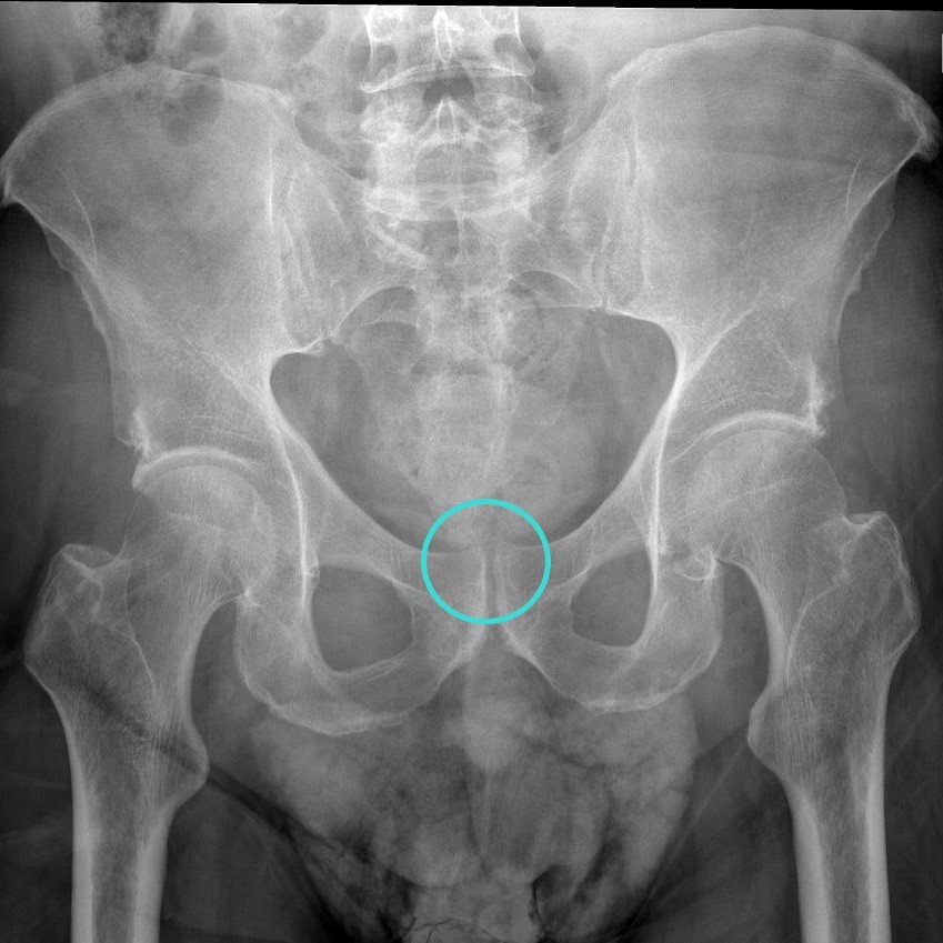 Anatomie – Lokalisation der Prostata (Röntgenbild des Beckens)