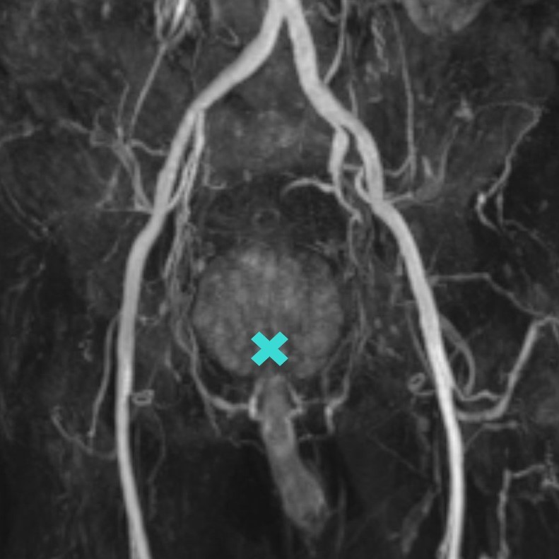 Anatomie – Lokalisation der Prostata und ihre Gefäßversorgung (MRT)