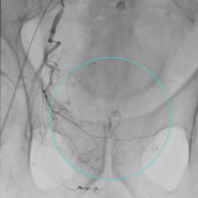 Angiographie vor Embolisation: Zahlreiche kleine Gefäße versorgen die vergrößerte Prostata