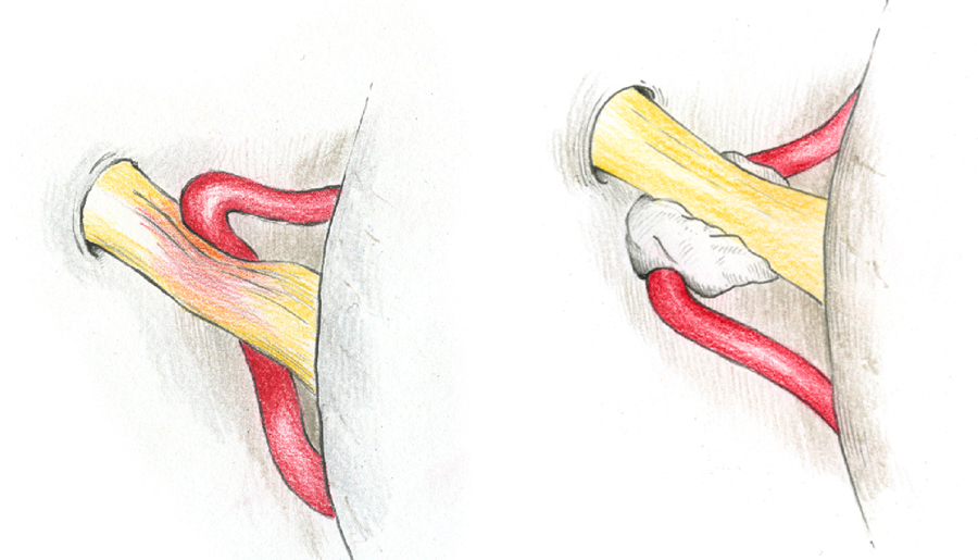 Die Abbildungen zeigen den Nervus trigeminus an seiner Austrittsstelle aus dem Hirnstamm, sowie eine den Nerven deutlich komprimierende Arterie. Nach Einbringen eines Teflonschwammes zwischen Arterie und Nerv ist dieser deutlich entlastet.