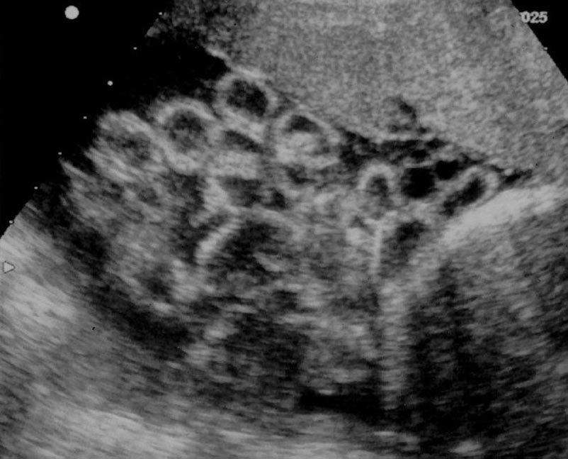 Gastroschisis