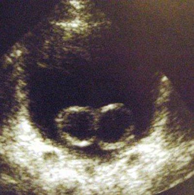 Beidseitige Ureterocelen im Ultraschall