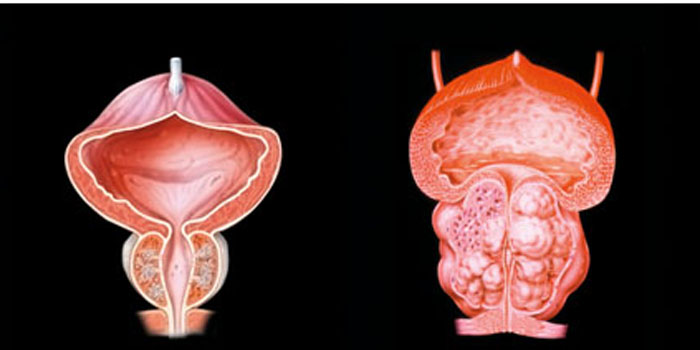 Prostata