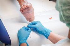 Botulinumtoxin-Behandlung der Fußsohle