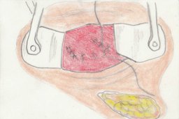 Behandlungsoption - Plastischer Fistelverschluss